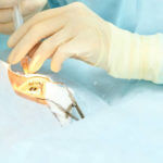 Ophthalmology laser microscope operation. Doctor in clinic. Patient eye treatment. Myopia and cataract removal.